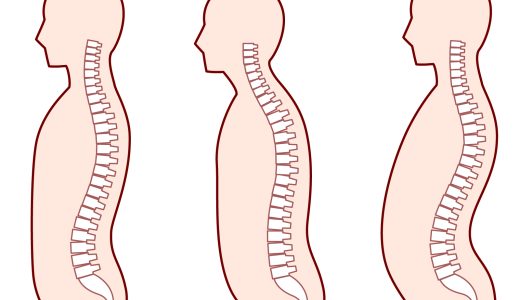 背骨の出っ張り、これ何？背骨が出っ張る原因と対策を徹底解説！